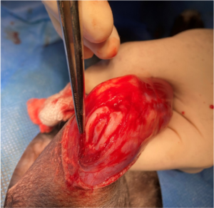 Surcoplastia en Cirugia luxacion de rotula